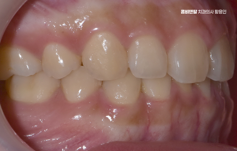 과개교합 교정 후 얼굴형 얼마나 바뀌나요 관련 이미지 3