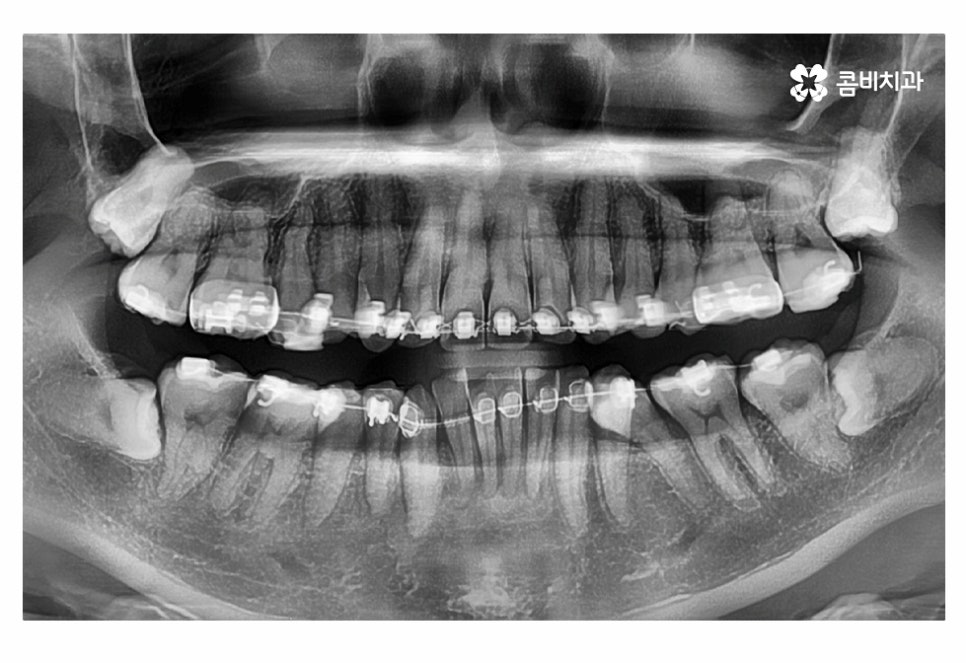치아설측교정 가능한지 궁금하다면 관련 이미지 10