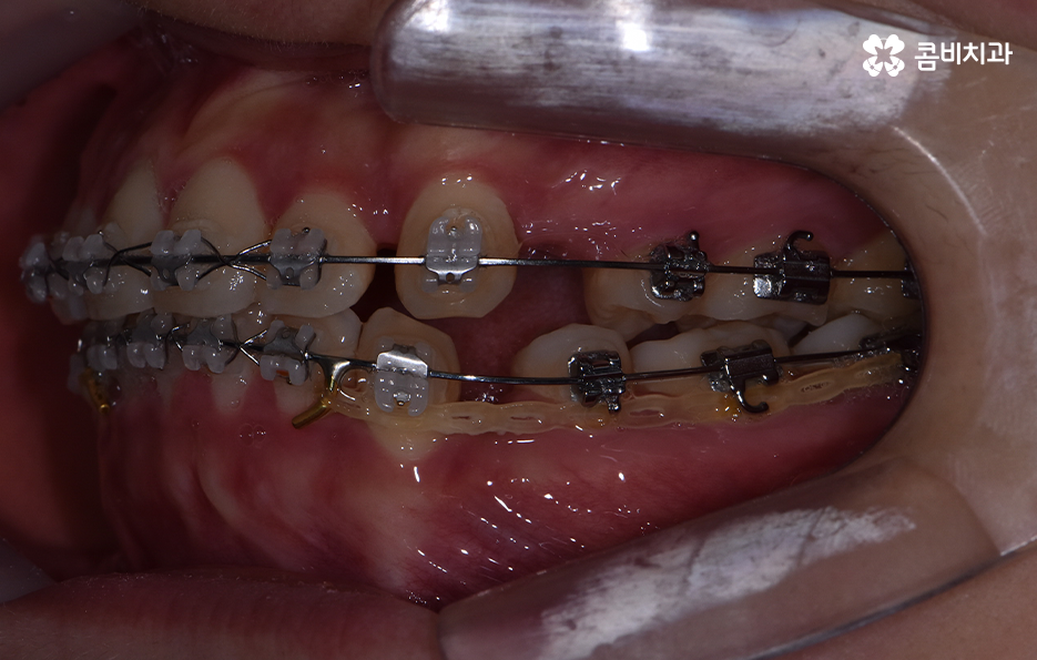 돌출입발치교정 기대해봐도 될까요 관련 이미지 10
