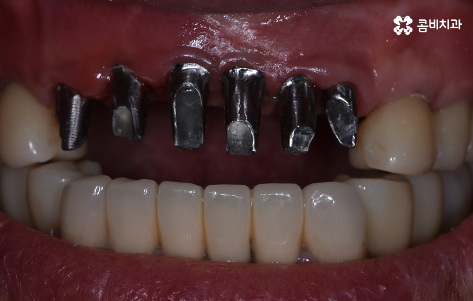 65세이상임플란트 고령이기에 간과하지 말아야 할 사항은 관련 이미지 8
