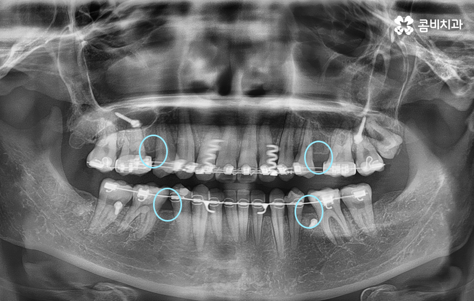 앞니치아교정 자연스러운 결과를 위해 알아둬야 할 점 관련 이미지 9