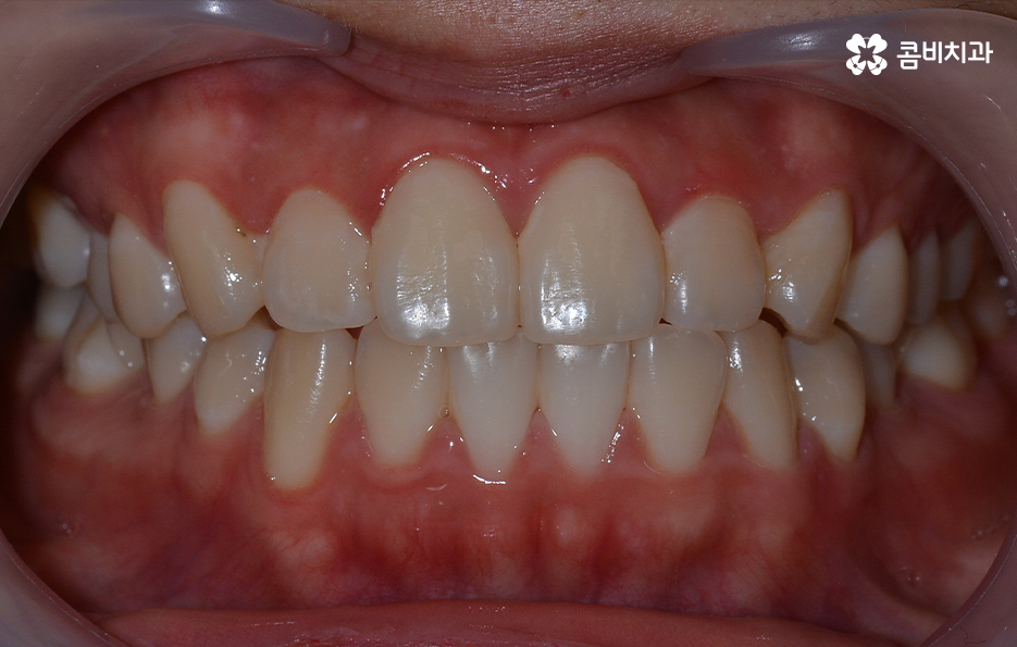 돌출입발치교정 기대해봐도 될까요 관련 이미지 1