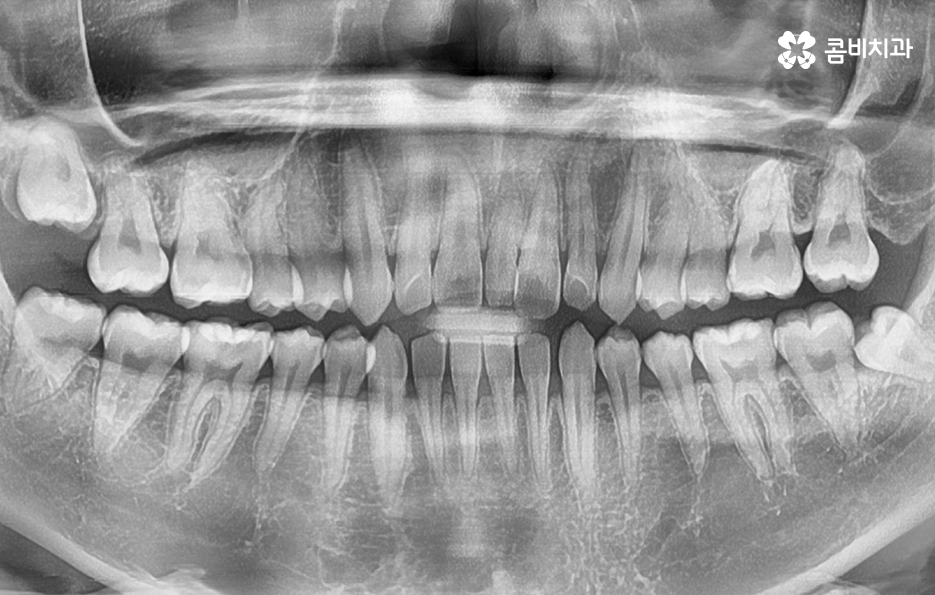 앞니만 교정 과잉치 뽑아서 해결했어요 관련 이미지 7