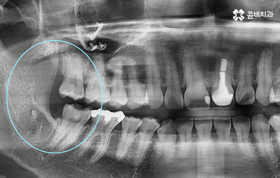 사랑니 발치 시기 이럴때 시작하면 좋아요 관련 이미지 7