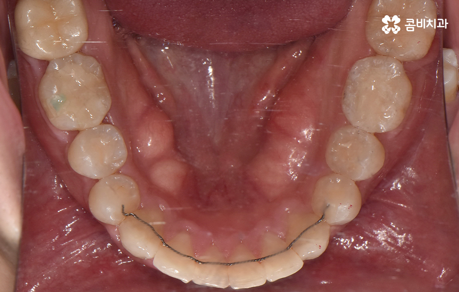 아랫니교정 이렇게만 파악하시면 됩니다 관련 이미지 15