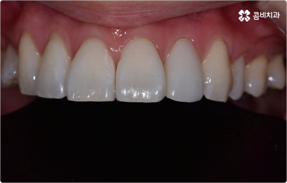 치아미백시술 관심있다면 관련 이미지 8