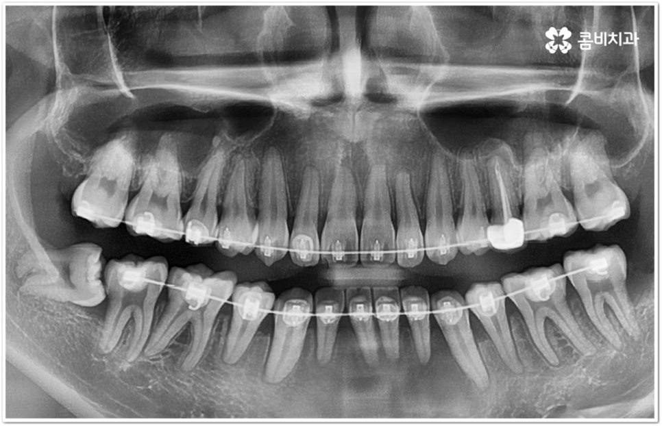 아래사랑니발치 망설이고 있다면 관련 이미지 10