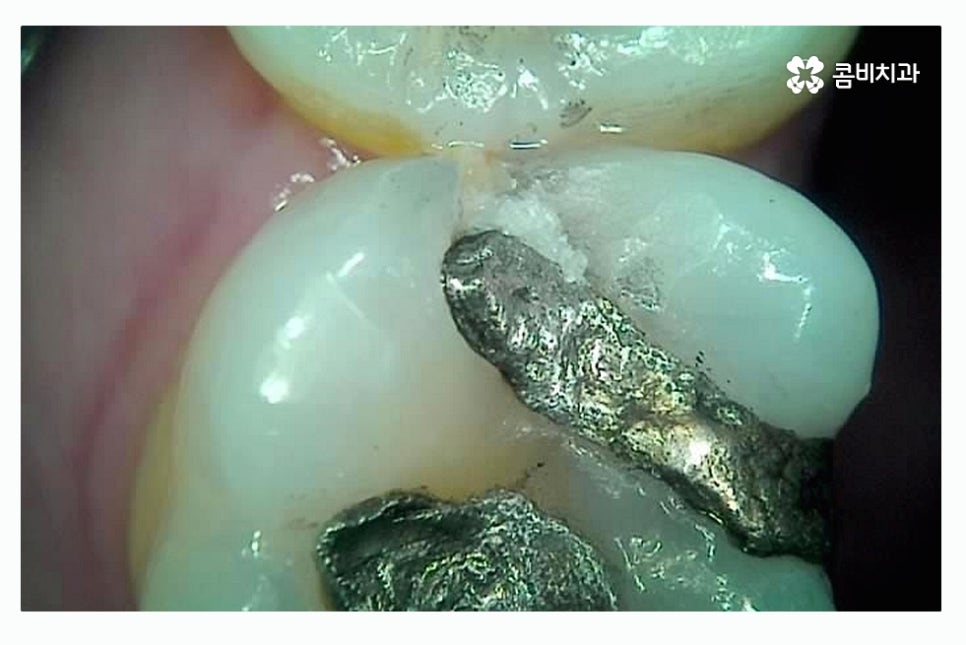 충치 레진 인레이 합리적으로 결정하려면 관련 이미지 7