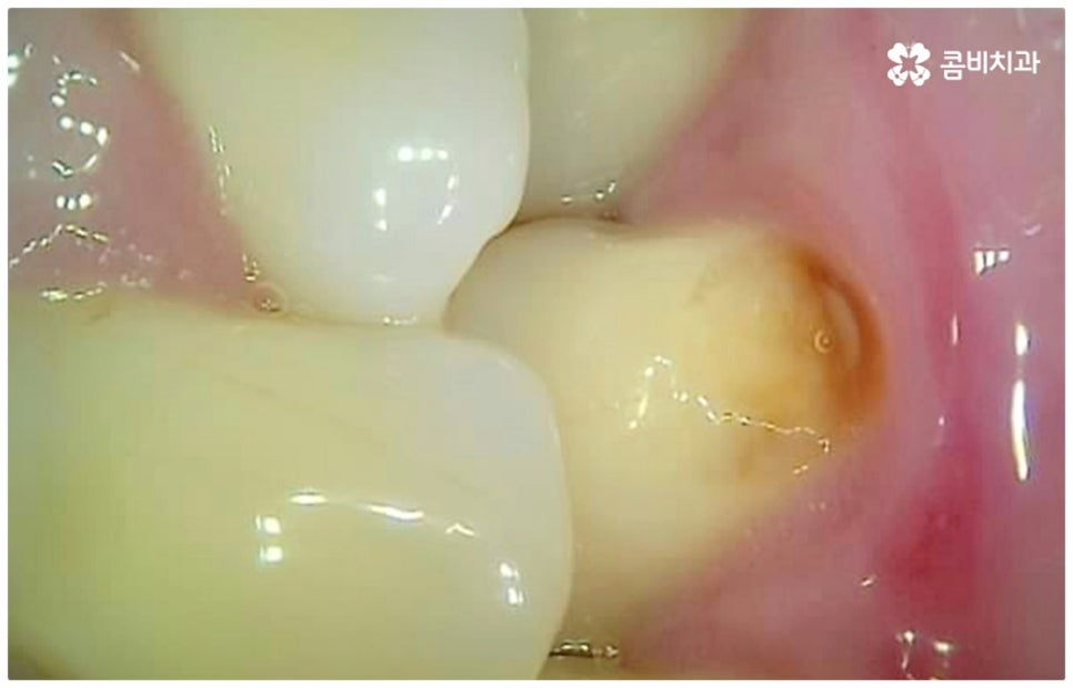 어금니충치치료 아프다면 빨리 관련 이미지 5