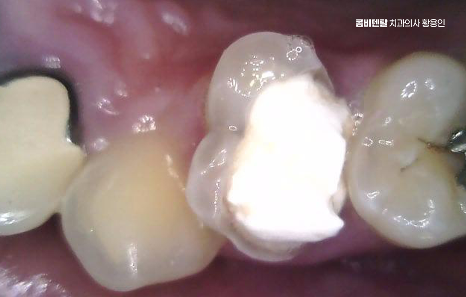 Be Careful Not to Delay Treatment for Cavities Between Your Teeth image 8