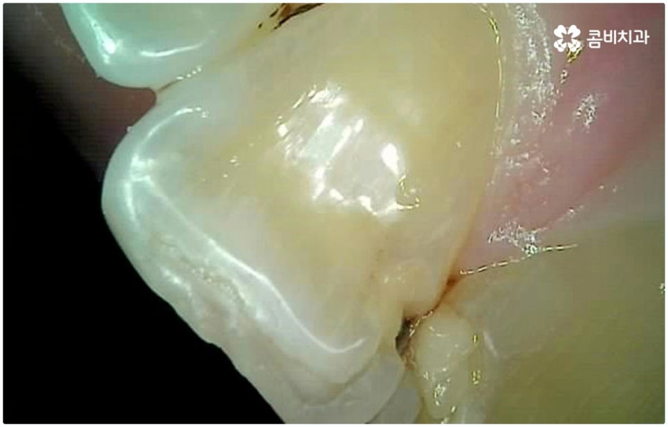 원데이임플란트 받고 싶으신가요? 관련 이미지 7
