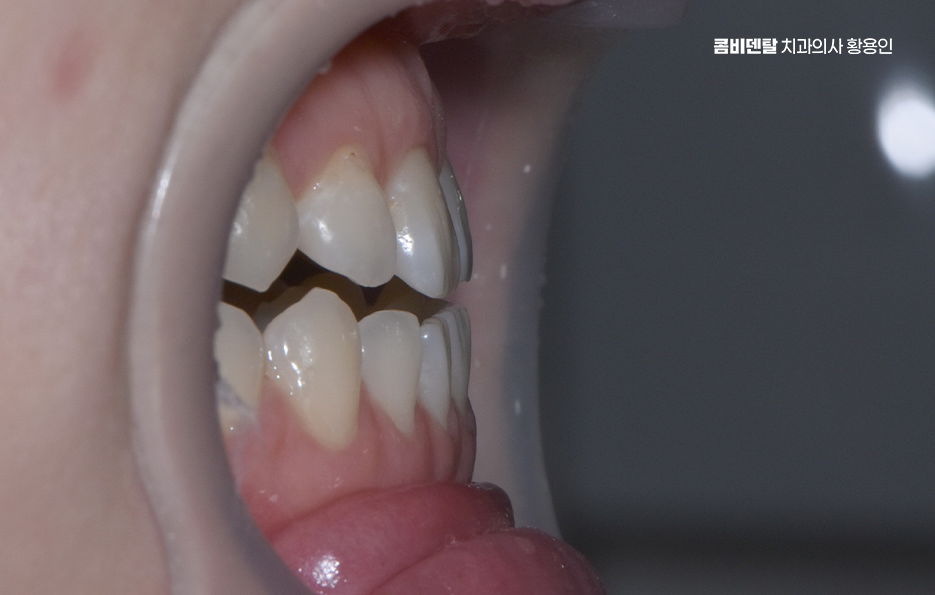 반대교합 치아교정 해결 가능할까 관련 이미지 4