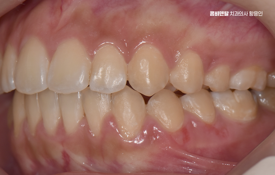 How Can You Determine the Duration of Front Teeth Orthodontic Treatment? image 12