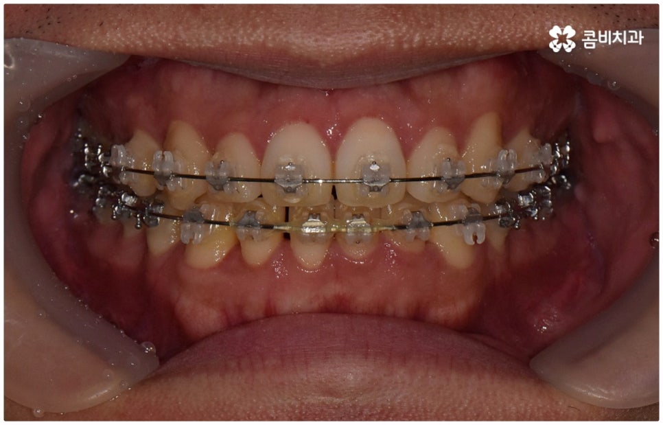 부정교합 3급 왜 고쳐야 하나요 관련 이미지 10