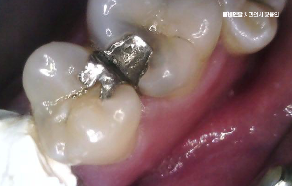 Be Careful Not to Delay Treatment for Cavities Between Your Teeth image 3
