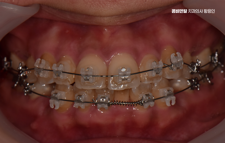 Could the Cause of Protruding Front Teeth Make a Difference? image 7