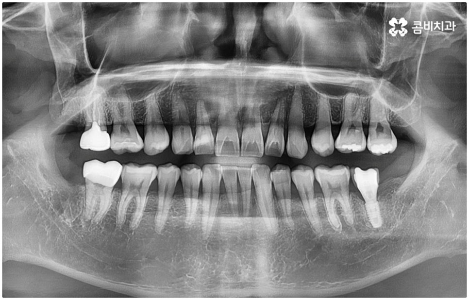 매복사랑니발치치과 어디로 가나요? 관련 이미지 3