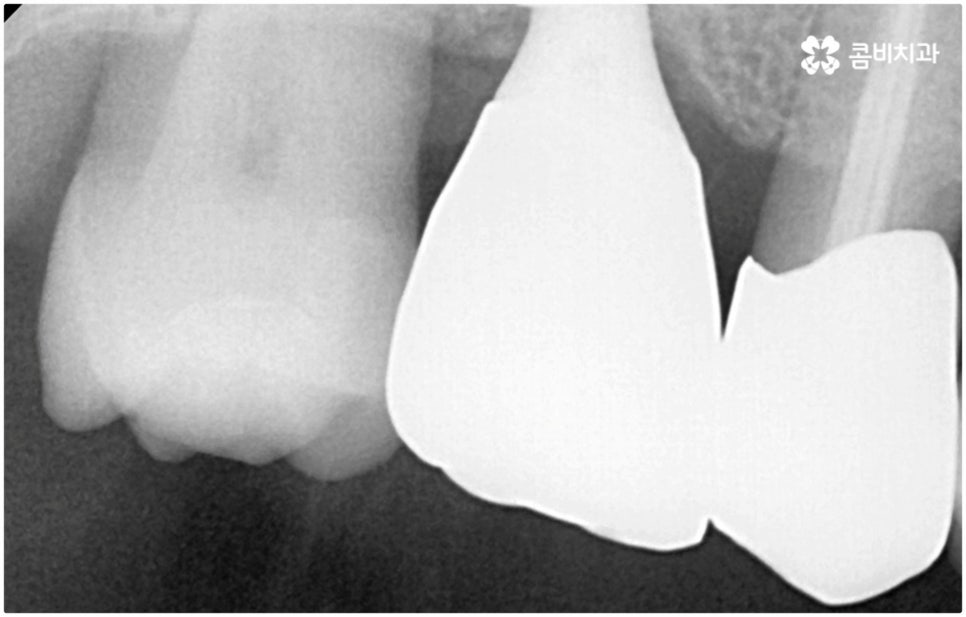 발치후 임플란트 바로 되나요? 관련 이미지 14