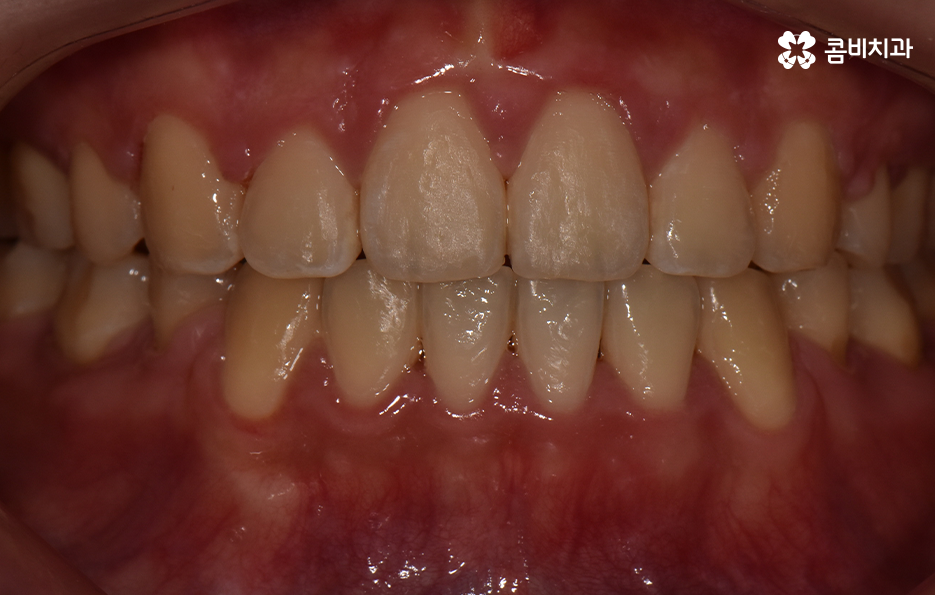 돌출입발치교정 기대해봐도 될까요 관련 이미지 11