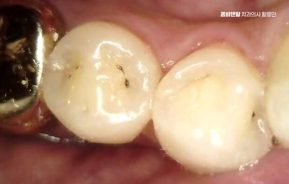 충치 치아 깨짐 시점이 관건이라면 관련 이미지 10