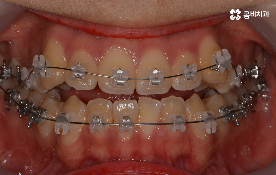 송곳니 덧니 뽑지 않고 해결된 사례 관련 이미지 8
