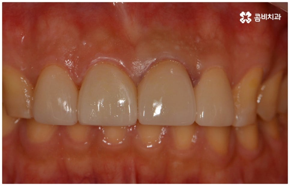 앞니충치치료 어떻게 이뤄지나요 관련 이미지 12