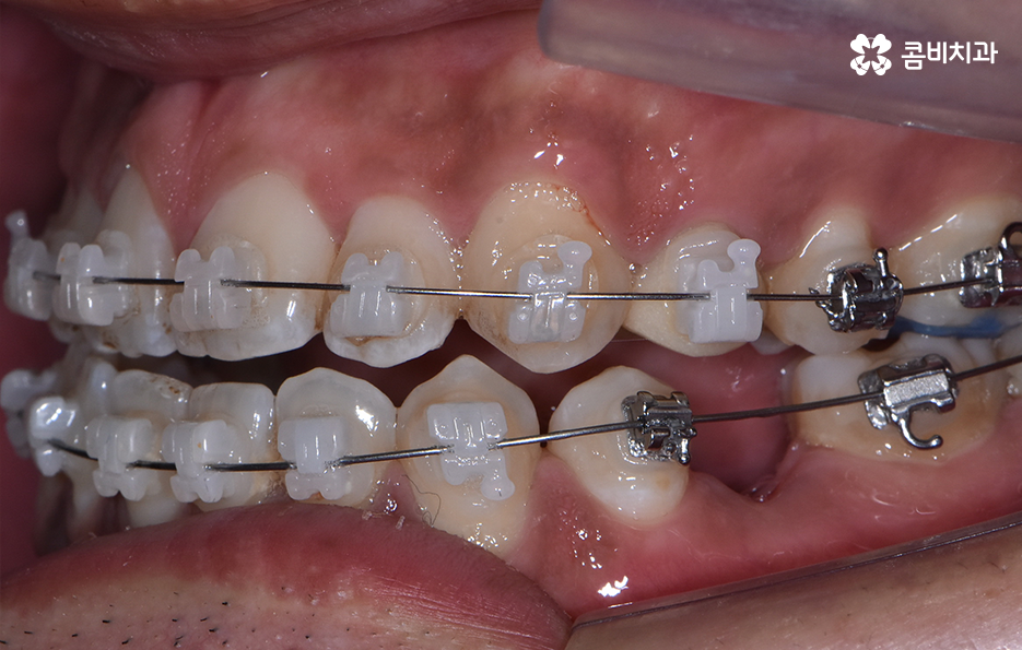 성인 부정교합 교정 더는 미루고 싶지 않다면 관련 이미지 6