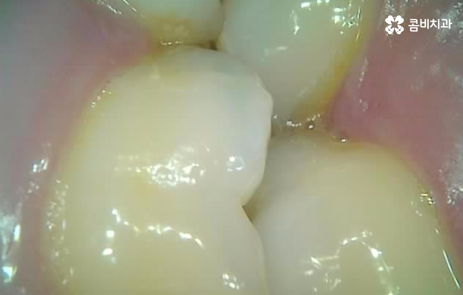 어금니 충치 깨짐 판단기준부터 세워보세요 관련 이미지 6