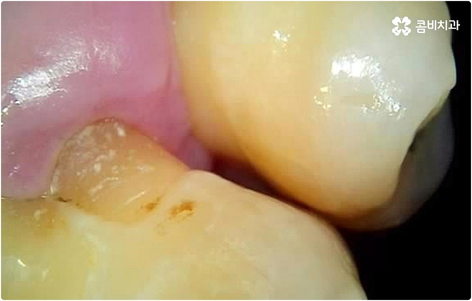20대임플란트 남의일이 아니라면 관련 이미지 11