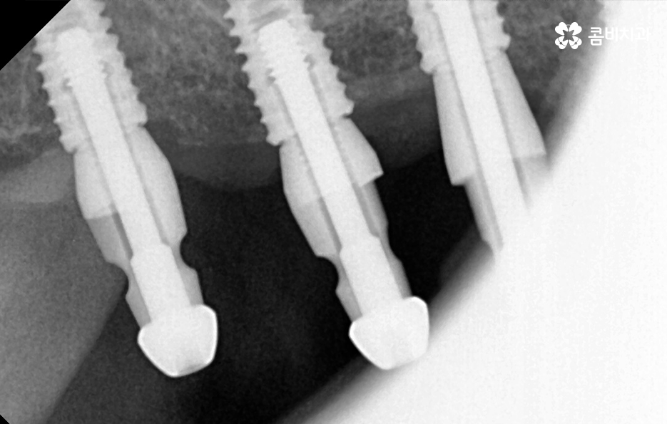 임플란트 치료기간 어느정도 걸리고 치과에는 몇번 가나요 관련 이미지 9