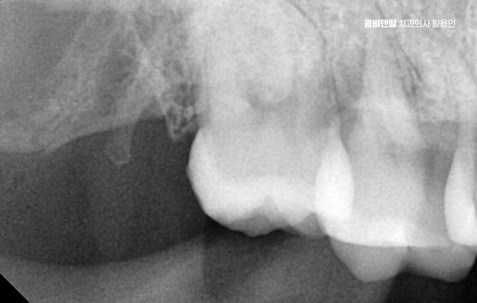 사랑니 주변 잇몸 통증 지금부터가 중요하니까 관련 이미지 9
