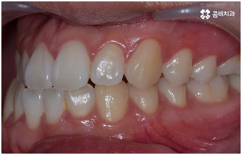 부정교합 3급 왜 고쳐야 하나요 관련 이미지 6