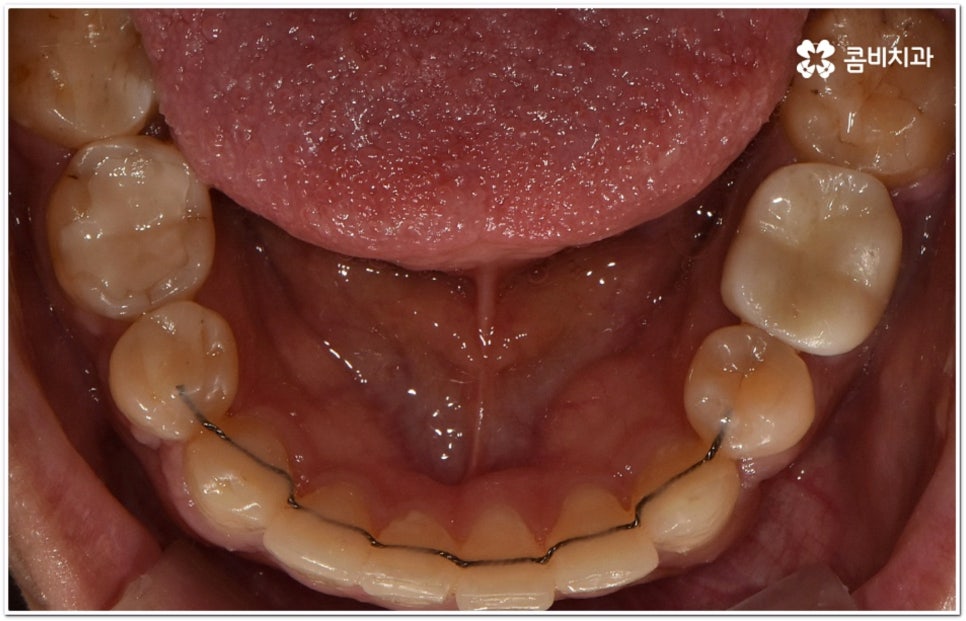 돌출입교정치과 알아보는 기준은 관련 이미지 17