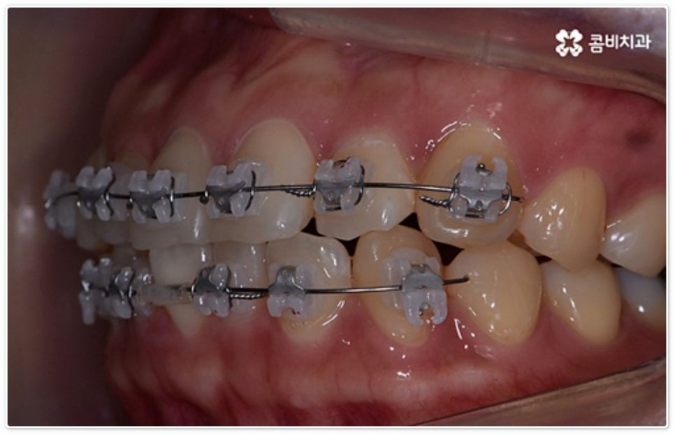 앞니부분교정 누구나 할수있나요? 관련 이미지 8