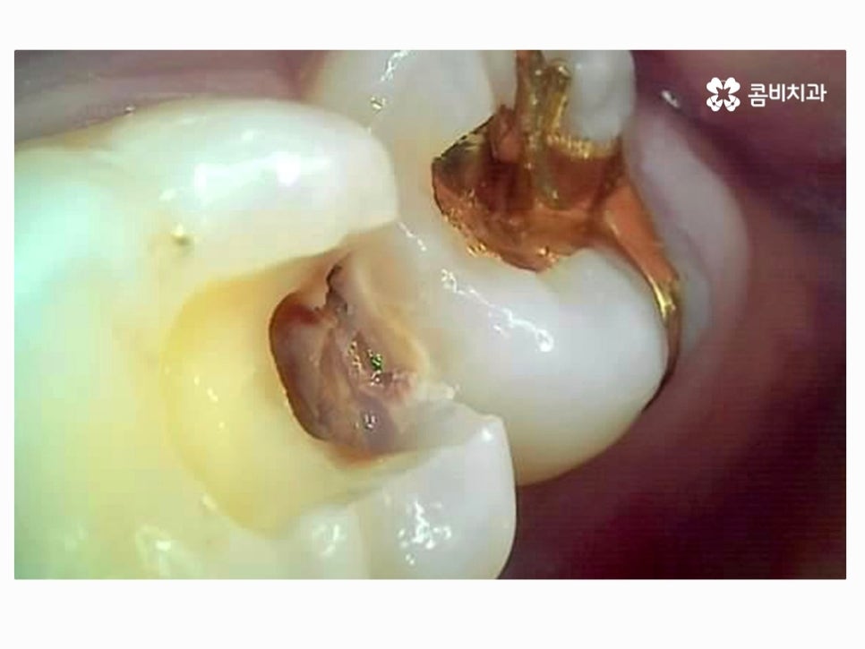 명동치과 누구나 놓치기 쉬운 문제점은! 관련 이미지 5