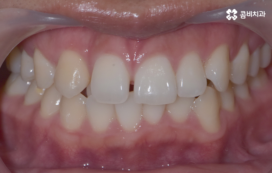 덧니 발치교정으로 교정할 때 치아가 이렇게 이동해요 관련 이미지 1