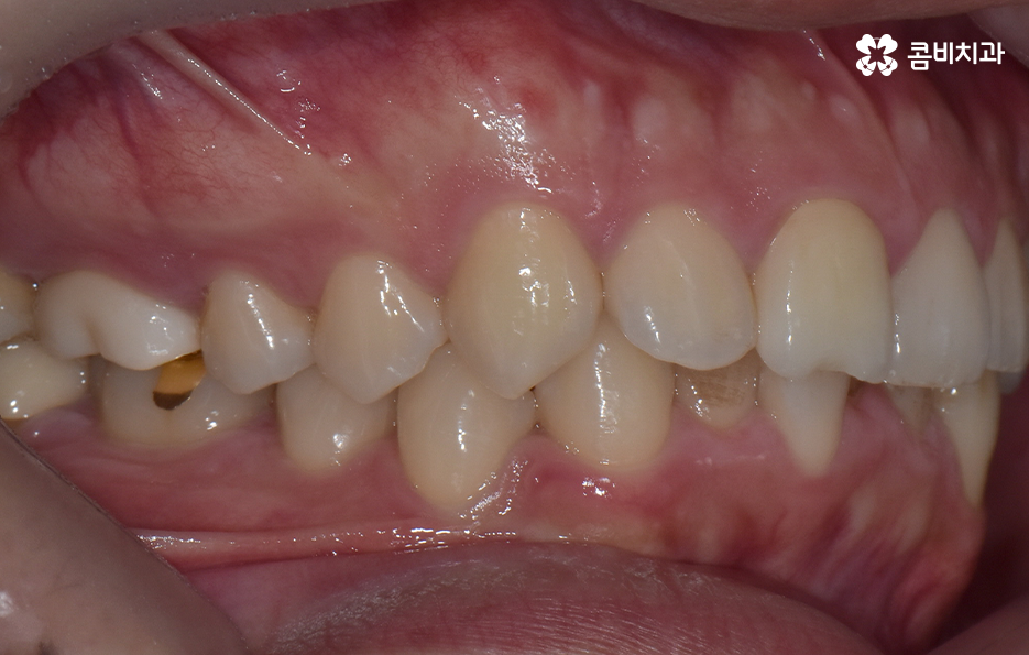 아랫니교정 이렇게만 파악하시면 됩니다 관련 이미지 2