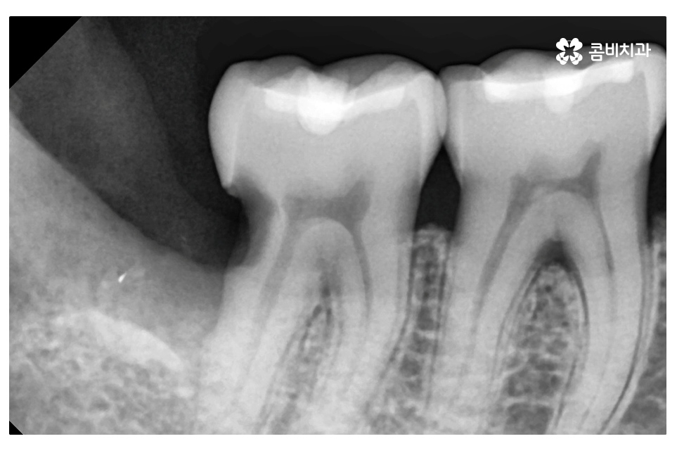 누운 사랑니 발치와 어금니신경치료를 하게 된 사례 관련 이미지 6