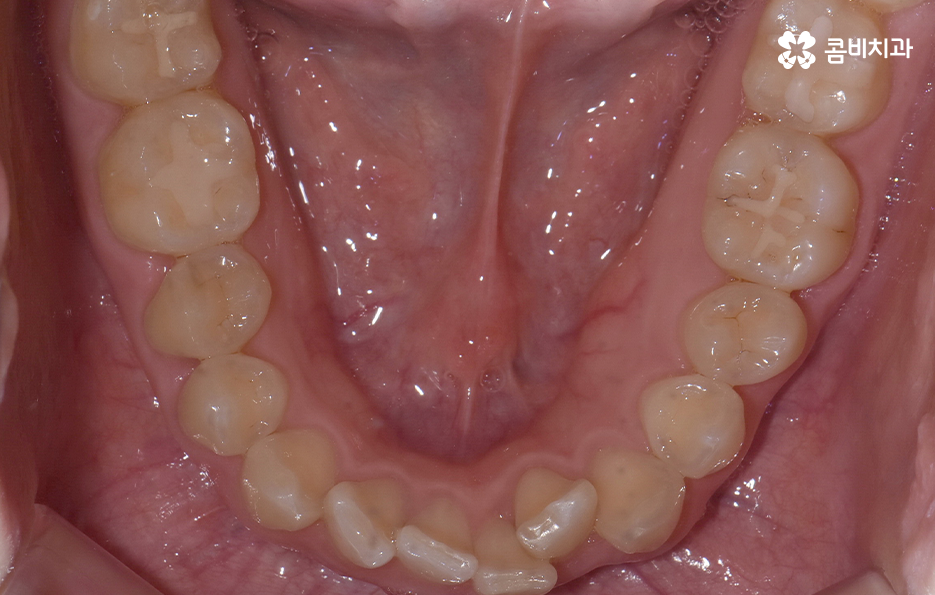 앞니 틀어짐 교정으로 해결하면 될까요 관련 이미지 6