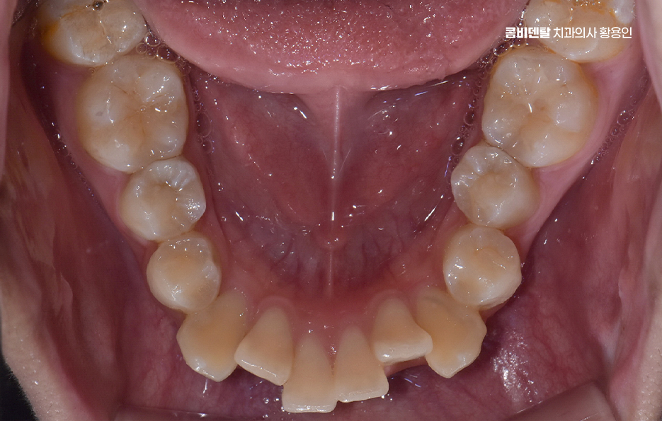 부정교합 교정 안하면 생기는 문제는 뭔가요 관련 이미지 6