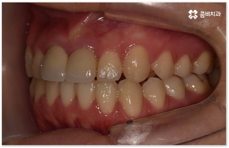 치아교정장치 어떻게 고르나요 관련 이미지 14