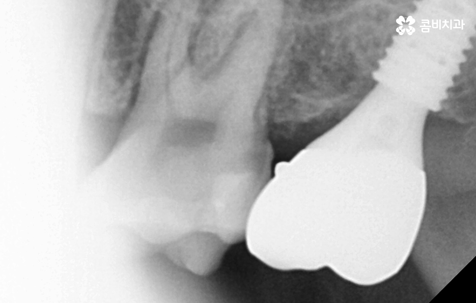 어금니 발치후 임플란트 이런점을 주의합시다 관련 이미지 8