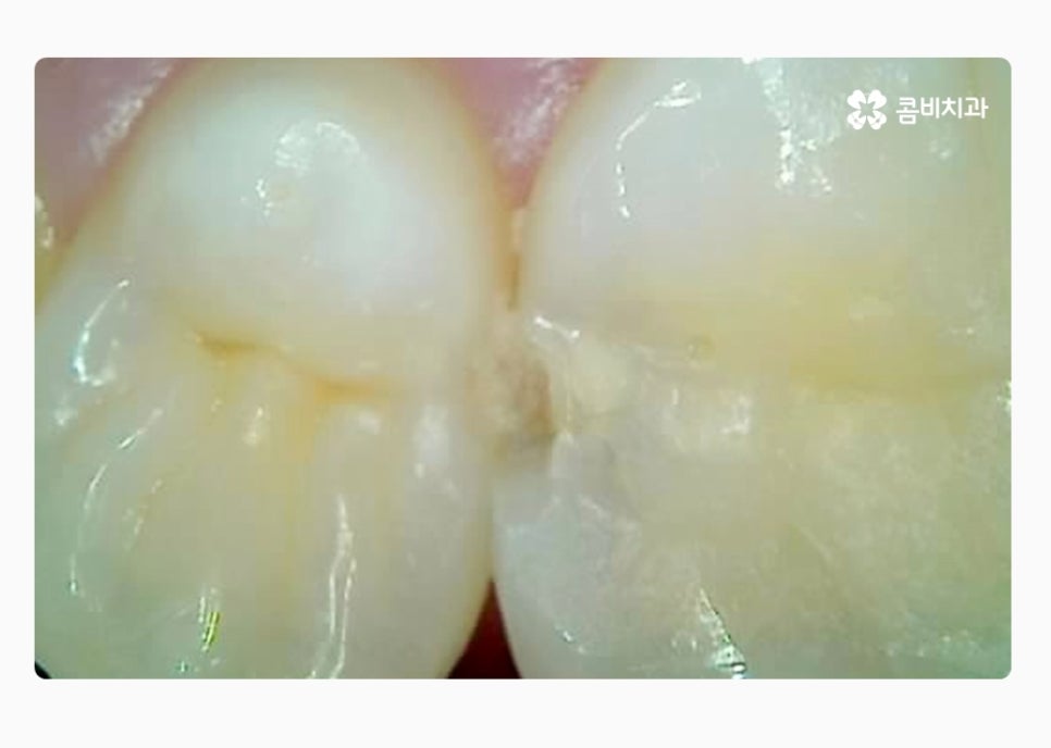 치아 사이 충치 육안으로는 알기 어려워요 관련 이미지 2
