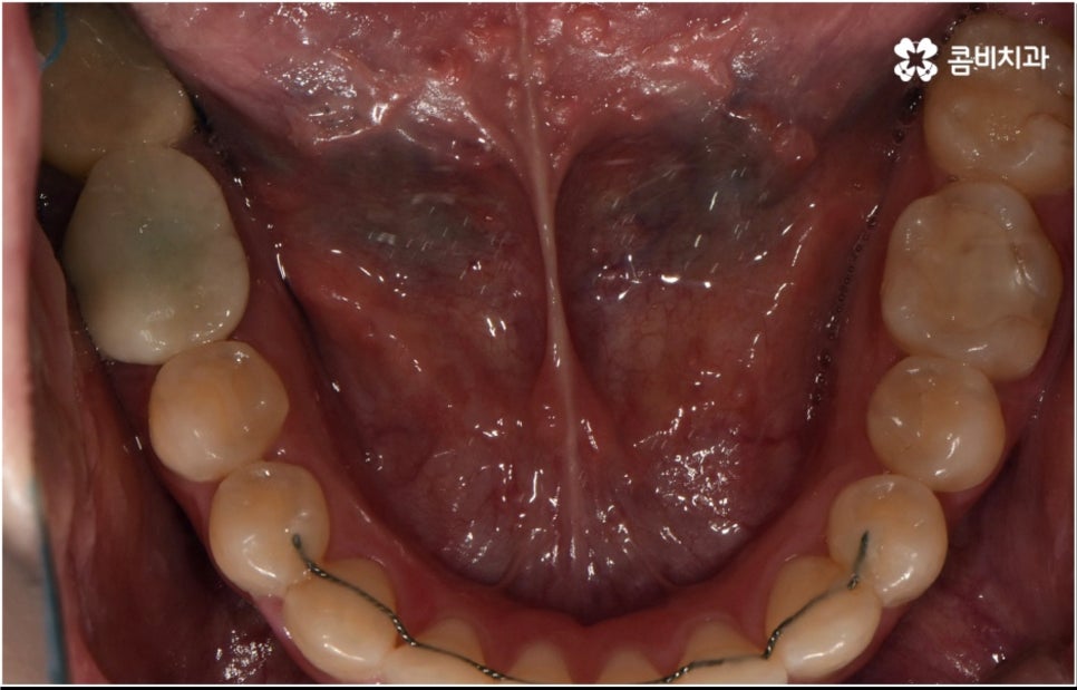 성인 치아교정 기간 걱정이 앞서나요 관련 이미지 16