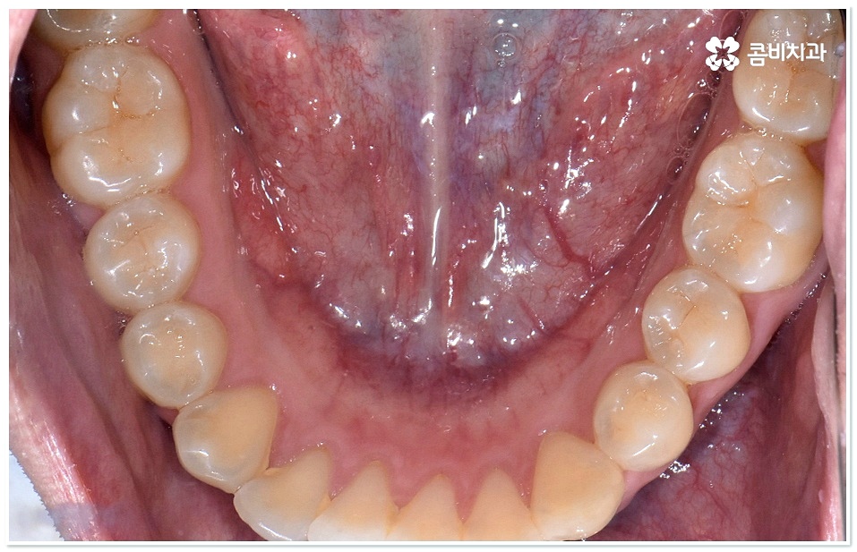 덧니치아교정 고려할 사항들은 관련 이미지 2