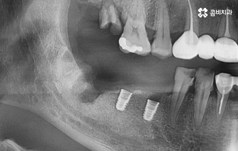 임플란트 치조골 상태에 따라 치료 계획도 달라지나요 관련 이미지 11