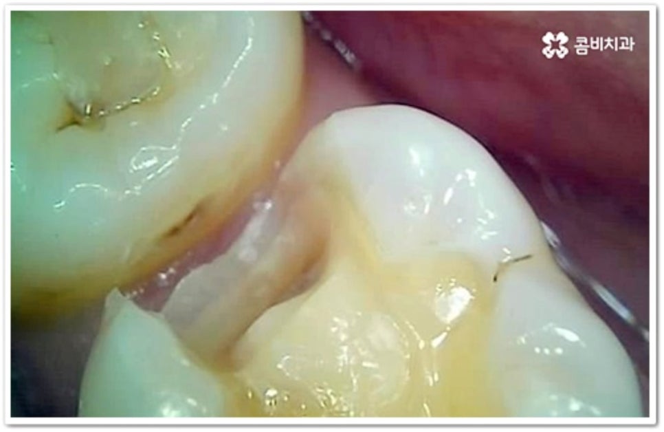 인접면 충치 어떻게 하나요 관련 이미지 9
