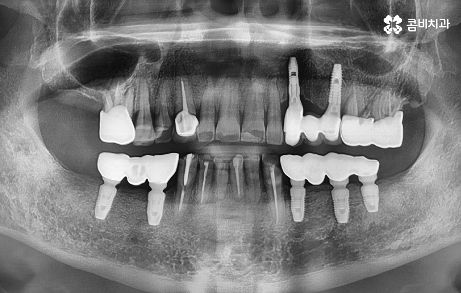 발치후 임플란트 기간 현실적으로 알아보면 관련 이미지 1