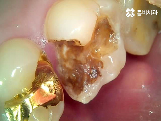 치아 깨짐 다시 튼튼하게 수복하기 위한 방법 관련 이미지 1