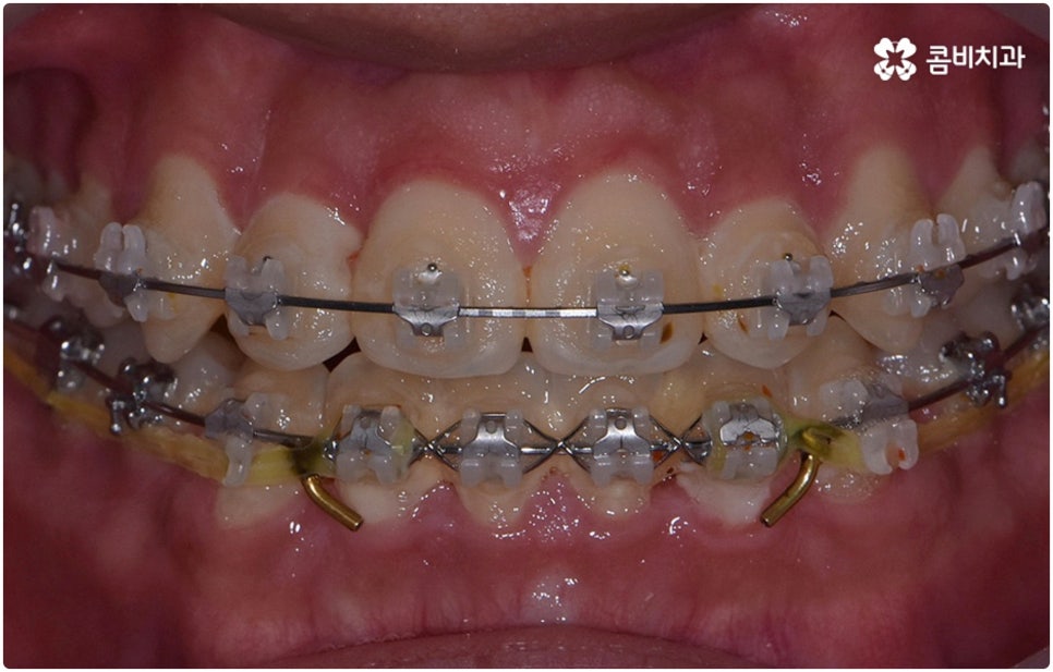부정교합 3급 고치는 방법은 관련 이미지 9
